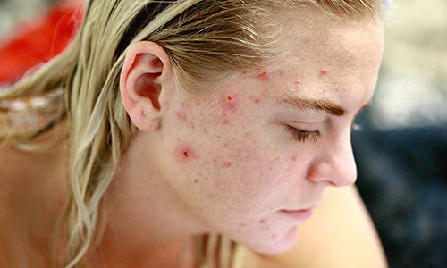 Behandla akne: Aknebehandling med manukahonung