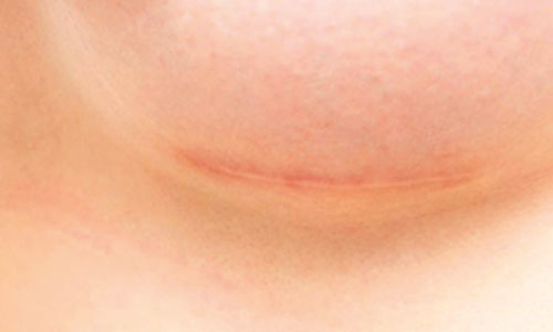 Ärrbehandling: Få bort ärr med silikontejp